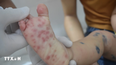 Hanói lança campanha para prevenir e controlar a doença mão-pé-boca nas escolas.