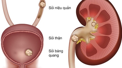 5 penyebab yang meningkatkan risiko batu ureter dan metode pencegahan yang efektif.