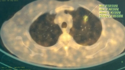 L'hôpital Bach Mai développe une intelligence artificielle pour faciliter le diagnostic précis du cancer du poumon.