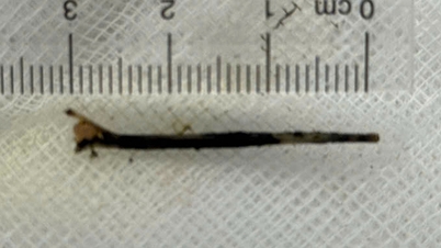 Rare case: 3cm fish bone pierces bile duct.