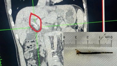 Safra kanalıma 3 cm uzunluğunda bir balık kılçığı takıldı... Kanser sandım.