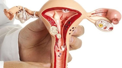Mengapa fibroid rahim mempersulit wanita untuk hamil?