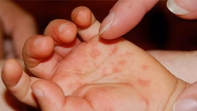 With an increase in hand, foot, and mouth disease cases, the Ministry of Health requests strengthened disease control measures.