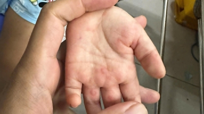 Alarming increase in child deaths due to hand, foot, and mouth disease.