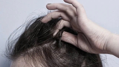 Tật giật, nhổ tóc gây tổn thương da đầu và sức khoẻ tinh thần như thế nào?