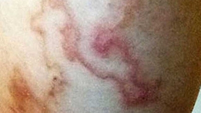 How dangerous is it if many people in Khanh Hoa test positive for parasitic diseases without early treatment?