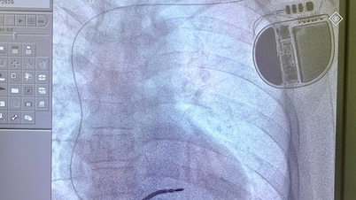 A man who fainted three times and suffered cardiac arrest once, facing a high risk of sudden death, was saved thanks to a technique implemented for the first time.