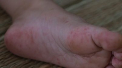 Hand, foot and mouth disease and dengue fever are on the rise in Can Tho.
