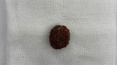 Ho Chi Minh City: Man suffers urinary tract obstruction after believing online "kidney stone dissolving medicine".