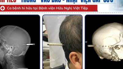 Man hospitalized after being hit in the head by a dart.