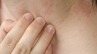 قد تكون الحكة المستمرة علامة تحذير مبكرة على الفشل الكلوي.