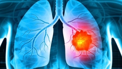 AI becomes the "all-seeing eye" to help screen for lung cancer.