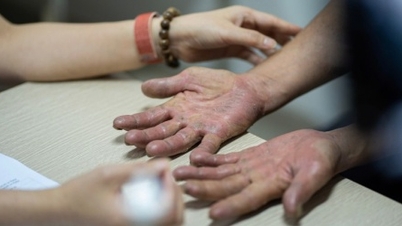 Skin diseases tend to flare up during hot weather; doctors advise on how to prevent them.