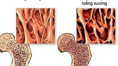 5 giải pháp đơn giản giúp duy trì xương chắc khỏe sau tuổi 50