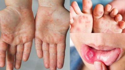 Cảnh báo bệnh tay chân miệng và sốt xuất huyết tiếp tục gia tăng, nhiều ca nặng