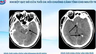Bệnh viện Hữu nghị Việt Tiệp cứu sống bệnh nhân 24 tuổi bị đột quỵ