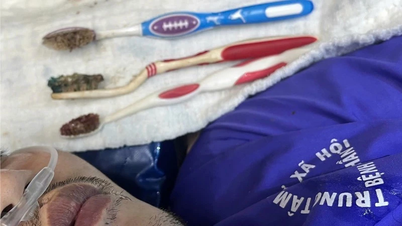 Endoscopy removes 3 toothbrushes from patient's digestive tract.