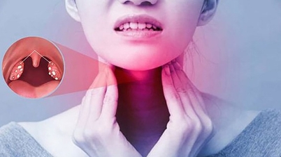 Warum tritt die granuläre Pharyngitis so leicht wieder auf?