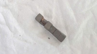 Emergency treatment for a boy who swallowed multiple magnets.