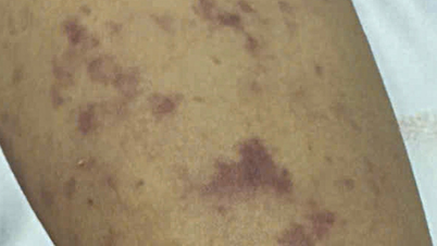 Méningite à méningocoque : 1 enfant décède.