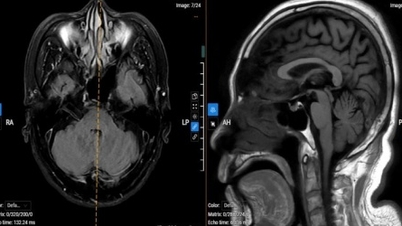A Parkinson-kórt könnyen összetévesztik az életkorral összefüggő öregedéssel, ami növeli a leghatékonyabb kezelési időszak elmulasztásának kockázatát.