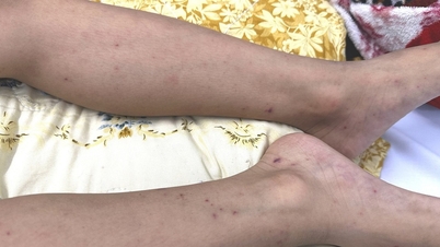 Bandar Raya Ho Chi Minh: Budak lelaki berusia 7 tahun yang menghidap penyakit meningokokal diselamatkan.