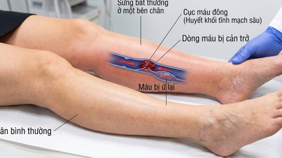 5 dấu hiệu cục máu đông ở chân có thể gây thuyên tắc phổi