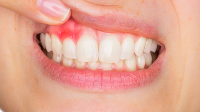 Bolehkah penyakit periodontal sembuh sepenuhnya?