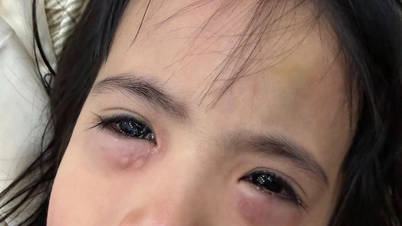 シャボン玉で遊んでいた5歳の少女が、結膜炎で入院した。