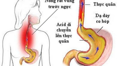 5 rizik užívání více léků snižujících kyselost u lidí s gastroezofageální refluxní chorobou.