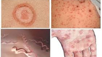 Lao Cai setzt Maßnahmen zur Prävention und Bekämpfung von Syphilis in der Region um.