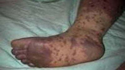 Meningite meningocócica: prevenção proativa - detecção precoce - tratamento oportuno.
