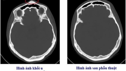 ویتنام-سویڈن Uong Bi ہسپتال نے کھوپڑی کی ہڈی کے ایک نایاب رسولی پر کامیابی سے سرجری کی۔