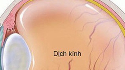 Flies in front of the eyes can be a sign of dangerous vitreous hemorrhage.