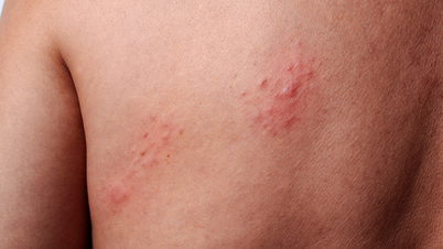 Cómo cuidar la piel después de padecer herpes zóster para evitar complicaciones a largo plazo.
