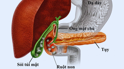 کون سی غذائیں پتھری کو روکنے میں مدد کر سکتی ہیں؟