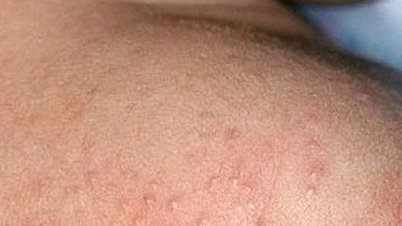 Mùa hè nhiều rôm sảy cần xử trí ra sao?