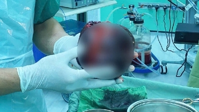 Hafif karın ağrısını önemsemeyen bir adam, kavun büyüklüğündeki bir tümör yüzünden neredeyse hayatını kaybediyordu.