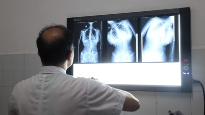 Nhận biết sớm dấu hiệu bệnh cong vẹo cột sống ở trẻ em