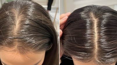 Advice for those who want to stimulate hair growth with vitamin B1.