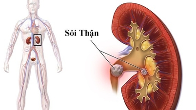 Hospitalized due to kidney stones, experts recommend early detection if these symptoms appear.