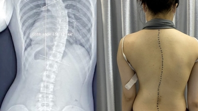 ຜົນສະທ້ອນຂອງໂຣກ scoliosis ໃນເດັກແມ່ນຫຍັງ?