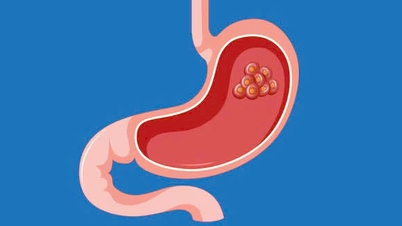 H. pylori bakterisinin mide kanserine neden olup olmadığına dair gerçekler.
