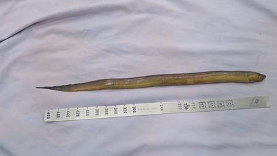 Intervention chirurgicale d'urgence pour retirer une anguille de 50 cm de long de l'estomac d'un patient.