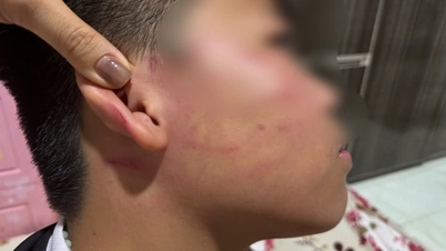 يجري التحقيق في قضية طالبة تبلغ من العمر 9 سنوات في جيا لاي تزعم تعرضها للإيذاء من قبل معلمها، مما أدى إلى إصابتها بطنين الأذن.