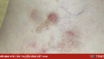 Số ca mắc ký sinh trùng gia tăng do thói quen ăn uống