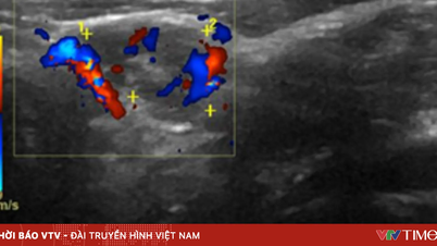 Parathyroid nodules: Vague symptoms, serious consequences.