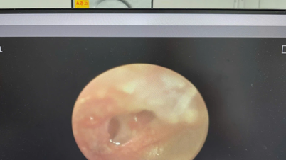 Man hospitalized after helping another man clean his earwax at night.