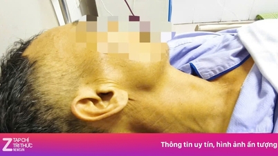 Poškození jater je vážné kvůli zlozvykům, které mnoho Vietnamců stále denně praktikuje.