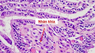Cancer de la thyroïde détecté lors d'un examen de routine.
